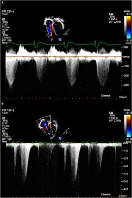 Echocardiographic Assessment of Pulmonary Arterial Hypertension for Pediatricians and Neonatologists